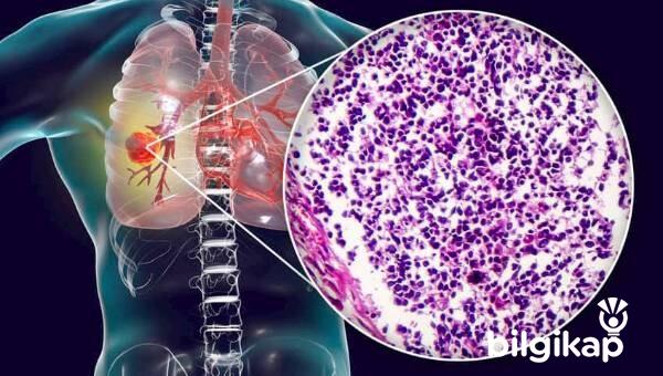 Akciğer Kanseri Nedir? Akciğer Kanserinin Bitkisel Tedavi Yöntemleri Nelerdir?  Sağlık